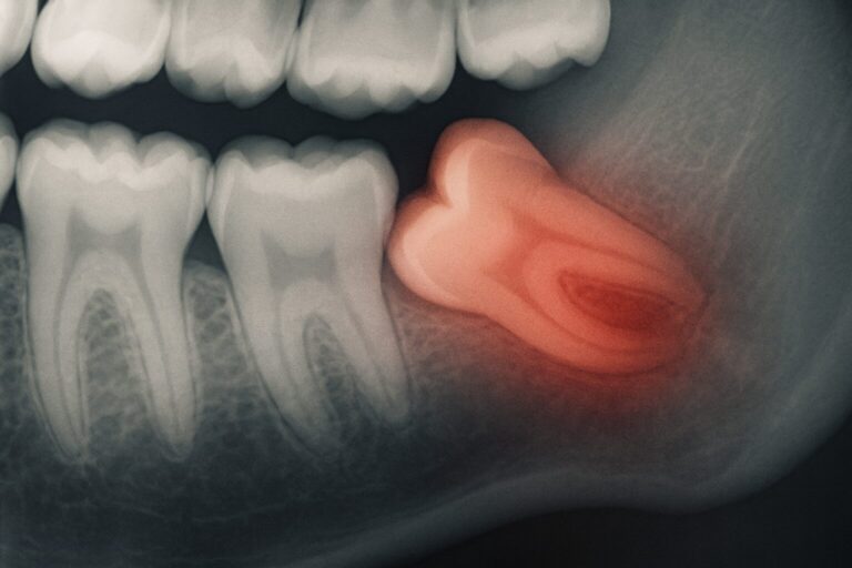 Chirurgiczne Usuwanie Ósemek Warszawa: Ekstrakcja Zęba Mądrości